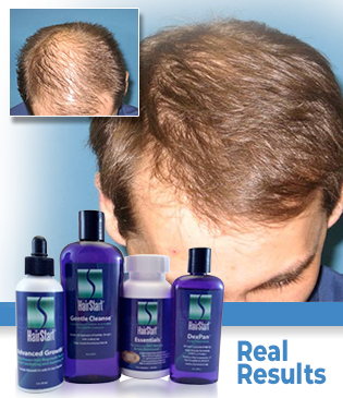 HairStart Treatments For Men