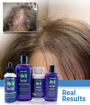 HairStart Treatments For Women